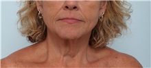 Neck Lift Before Photo by Paul Vitenas, Jr., MD; Houston, TX - Case 50003
