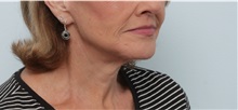 Neck Lift After Photo by Paul Vitenas, Jr., MD; Houston, TX - Case 50003