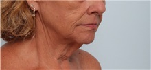 Neck Lift Before Photo by Paul Vitenas, Jr., MD; Houston, TX - Case 50003