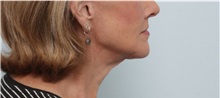 Neck Lift After Photo by Paul Vitenas, Jr., MD; Houston, TX - Case 50003