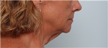 Neck Lift Before Photo by Paul Vitenas, Jr., MD; Houston, TX - Case 50003