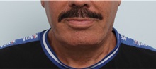 Neck Lift After Photo by Paul Vitenas, Jr., MD; Houston, TX - Case 50004