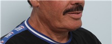 Neck Lift After Photo by Paul Vitenas, Jr., MD; Houston, TX - Case 50004