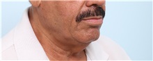 Neck Lift Before Photo by Paul Vitenas, Jr., MD; Houston, TX - Case 50004
