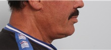 Neck Lift After Photo by Paul Vitenas, Jr., MD; Houston, TX - Case 50004