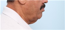 Neck Lift Before Photo by Paul Vitenas, Jr., MD; Houston, TX - Case 50004