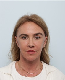 Facelift After Photo by Paul Vitenas, Jr., MD; Houston, TX - Case 50008