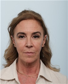 Facelift Before Photo by Paul Vitenas, Jr., MD; Houston, TX - Case 50008