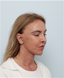 Facelift After Photo by Paul Vitenas, Jr., MD; Houston, TX - Case 50008