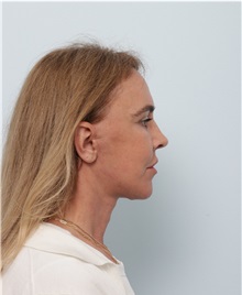 Facelift After Photo by Paul Vitenas, Jr., MD; Houston, TX - Case 50008