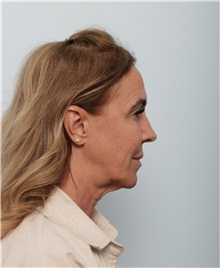 Facelift Before Photo by Paul Vitenas, Jr., MD; Houston, TX - Case 50008