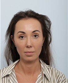 Chin Augmentation After Photo by Paul Vitenas, Jr., MD; Houston, TX - Case 50005