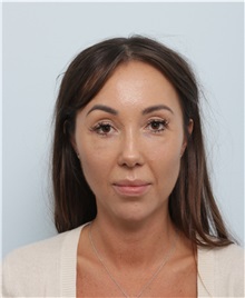 Chin Augmentation Before Photo by Paul Vitenas, Jr., MD; Houston, TX - Case 50005