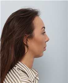 Chin Augmentation After Photo by Paul Vitenas, Jr., MD; Houston, TX - Case 50005