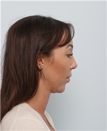 Chin Augmentation Before Photo by Paul Vitenas, Jr., MD; Houston, TX - Case 50005