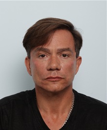 Facelift After Photo by Paul Vitenas, Jr., MD; Houston, TX - Case 50029