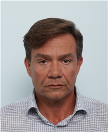 Facelift Before Photo by Paul Vitenas, Jr., MD; Houston, TX - Case 50029