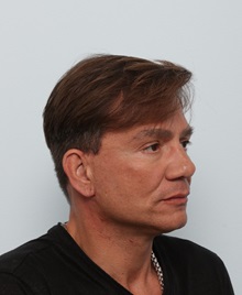 Facelift After Photo by Paul Vitenas, Jr., MD; Houston, TX - Case 50029