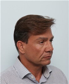 Facelift Before Photo by Paul Vitenas, Jr., MD; Houston, TX - Case 50029