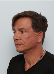 Facelift After Photo by Paul Vitenas, Jr., MD; Houston, TX - Case 50029