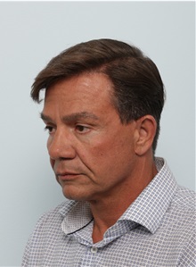 Facelift Before Photo by Paul Vitenas, Jr., MD; Houston, TX - Case 50029