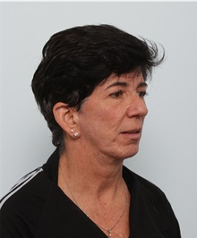 Facelift Before Photo by Paul Vitenas, Jr., MD; Houston, TX - Case 50027