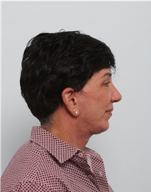 Facelift After Photo by Paul Vitenas, Jr., MD; Houston, TX - Case 50027