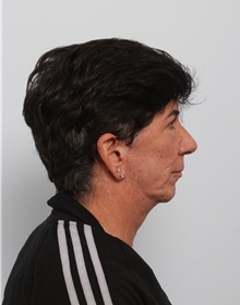Facelift Before Photo by Paul Vitenas, Jr., MD; Houston, TX - Case 50027