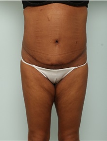 Tummy Tuck After Photo by Paul Vitenas, Jr., MD; Houston, TX - Case 50028