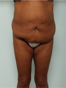 Tummy Tuck Before Photo by Paul Vitenas, Jr., MD; Houston, TX - Case 50028
