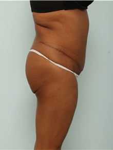 Tummy Tuck After Photo by Paul Vitenas, Jr., MD; Houston, TX - Case 50028