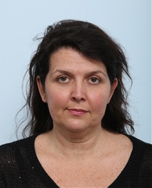 Facelift Before Photo by Paul Vitenas, Jr., MD; Houston, TX - Case 50030