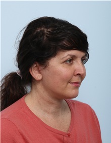 Facelift After Photo by Paul Vitenas, Jr., MD; Houston, TX - Case 50030