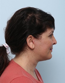 Facelift After Photo by Paul Vitenas, Jr., MD; Houston, TX - Case 50030