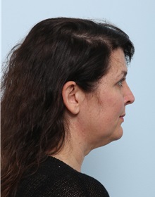 Facelift Before Photo by Paul Vitenas, Jr., MD; Houston, TX - Case 50030