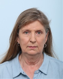 Facelift Before Photo by Paul Vitenas, Jr., MD; Houston, TX - Case 50031