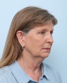 Facelift Before Photo by Paul Vitenas, Jr., MD; Houston, TX - Case 50031