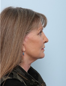 Facelift After Photo by Paul Vitenas, Jr., MD; Houston, TX - Case 50031