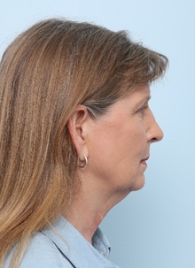 Facelift Before Photo by Paul Vitenas, Jr., MD; Houston, TX - Case 50031