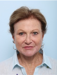 Facelift After Photo by Paul Vitenas, Jr., MD; Houston, TX - Case 50032