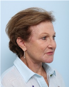 Facelift After Photo by Paul Vitenas, Jr., MD; Houston, TX - Case 50032