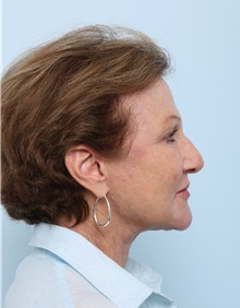 Facelift After Photo by Paul Vitenas, Jr., MD; Houston, TX - Case 50032