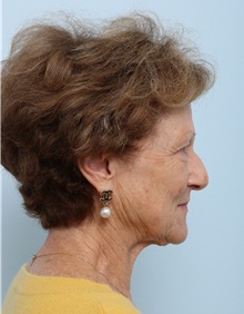 Facelift Before Photo by Paul Vitenas, Jr., MD; Houston, TX - Case 50032