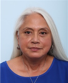 Facelift After Photo by Paul Vitenas, Jr., MD; Houston, TX - Case 50033