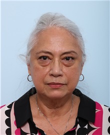 Facelift Before Photo by Paul Vitenas, Jr., MD; Houston, TX - Case 50033
