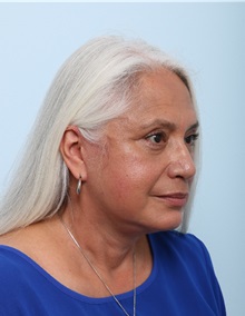 Facelift After Photo by Paul Vitenas, Jr., MD; Houston, TX - Case 50033