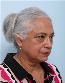 Facelift Before Photo by Paul Vitenas, Jr., MD; Houston, TX - Case 50033