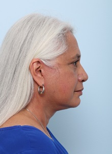 Facelift After Photo by Paul Vitenas, Jr., MD; Houston, TX - Case 50033