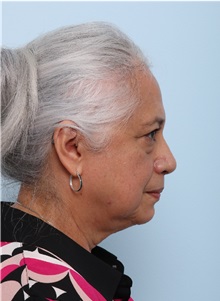Facelift Before Photo by Paul Vitenas, Jr., MD; Houston, TX - Case 50033