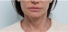Facelift After Photo by Paul Vitenas, Jr., MD; Houston, TX - Case 50072